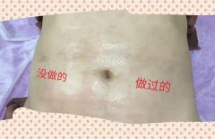 去妊娠紋機器多少錢一臺？美容院去除妊娠紋機器設(shè)備價格